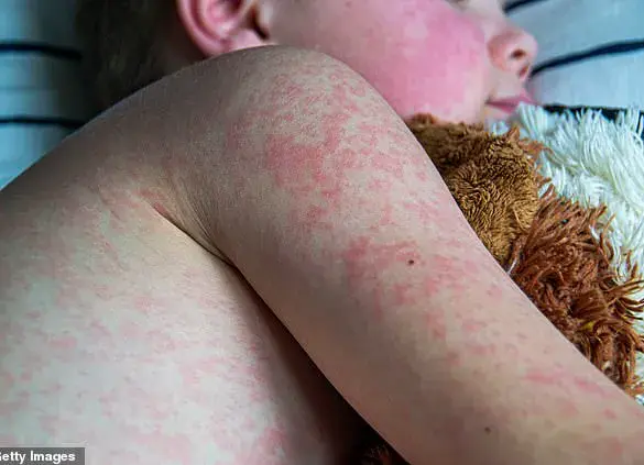 Measles Cases Surpass Previous Yearly Totals in Just Three Months, CDC Reports