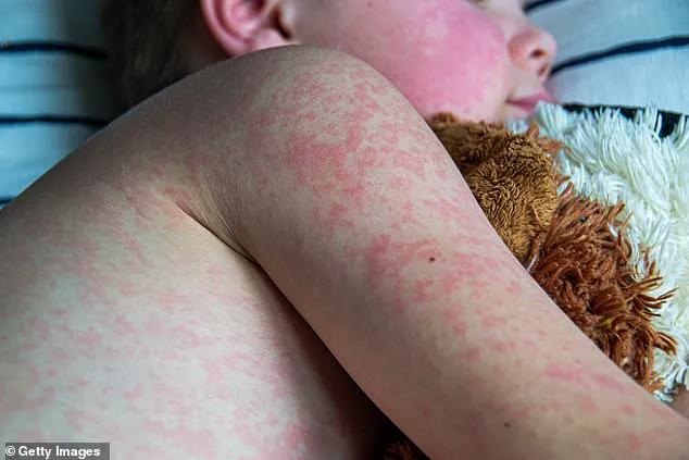 Measles Cases Surpass Previous Yearly Totals in Just Three Months, CDC Reports