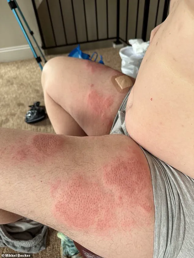 Ryan Battles Rare and Aggressive Pyoderma Gangrenosum as Family Seeks Expert Medical Advice