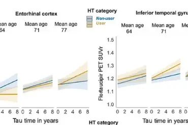 Study Links Late-Life Hormone Replacement Therapy to Increased Alzheimer's Risk