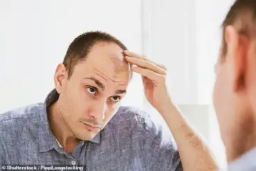 Sweet Drink Consumption Linked to Male Pattern Hair Loss