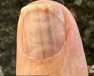 The Faint Black Lines on My Thumb That Saved My Life