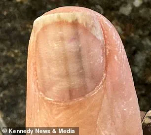 The Faint Black Lines on My Thumb That Saved My Life