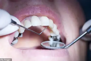 UK Dentists See Surge in Requests for Removal of Banned Amalgam Fillings