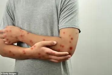 US college tells students to isolate over chickenpox outbreak