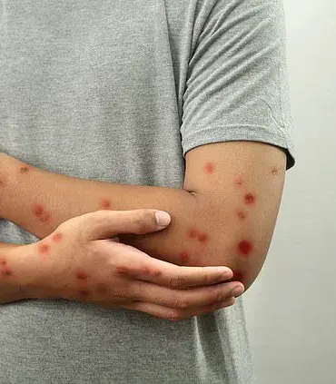 US college tells students to isolate over chickenpox outbreak