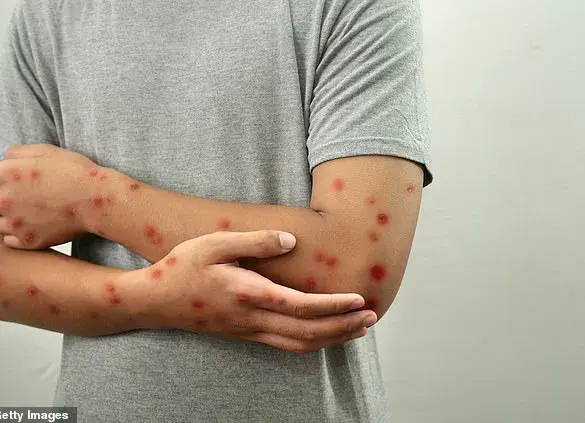 US college tells students to isolate over chickenpox outbreak