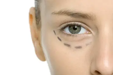 Blepharoplasty: A Quick-Recovery Option for Eye Rejuvenation