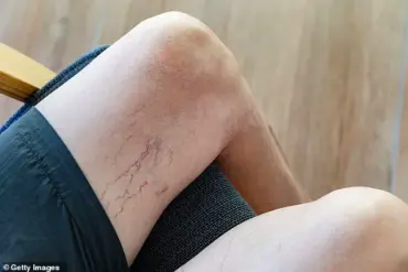 Top Doctor Reveals Unlikely Skin Signs of Liver Toxicity