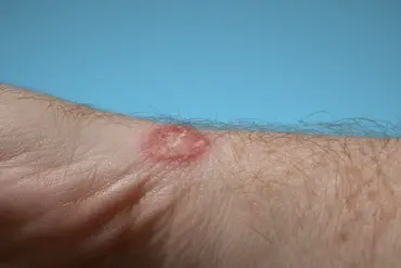 Warning: Used Clothing Can Spread Diseases Like Ringworm