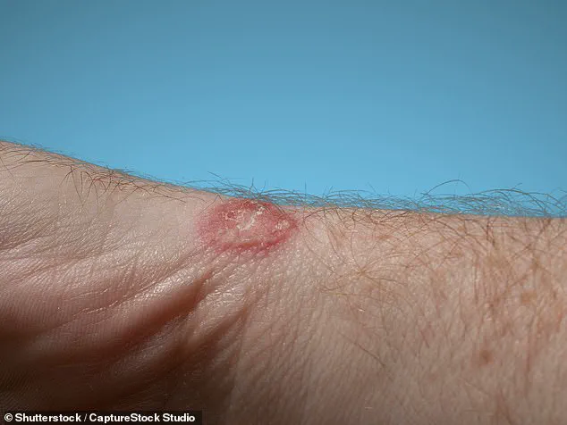 Warning: Used Clothing Can Spread Diseases Like Ringworm