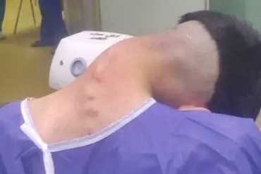 Dropped Head Syndrome: A Rare Consequence of Long-Term Drug Use Revealed in Shocking Images