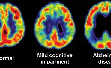 Early-Onset Alzheimer’s: A Mother’s Struggle with Memory Loss and Disorientation