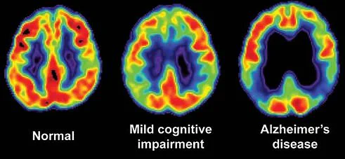 Early-Onset Alzheimer’s: A Mother’s Struggle with Memory Loss and Disorientation