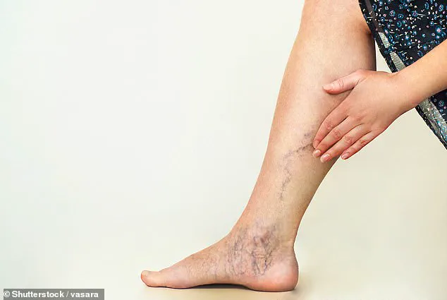 New Study Reveals Varicose Veins Linked to 23.5% Higher Dementia Risk, Urging Expert Advisories on Vascular Health