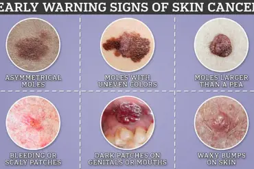 NHS Rolls Out Rapid Cancer 'Super Jab' for Thousands of Patients