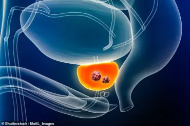 Revolutionary AI Test Developed by Artera Inc Identifies Prostate Cancer Biomarker, Paving the Way for New Treatment Approaches