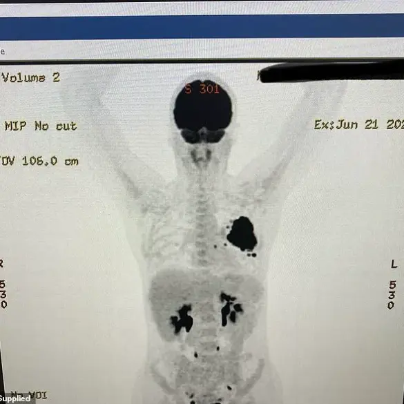 Rising Concern: Non-Smokers Face Late-Stage Lung Cancer, Highlighting Hidden Risks for Women
