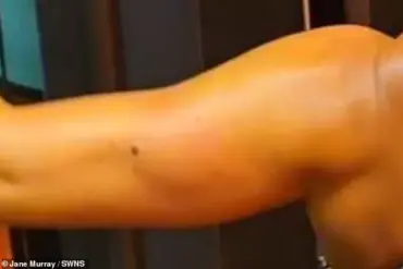 The Hidden Cost of Limited Access: How Jane Murray's Melanoma Battle Led to a Health Advocate