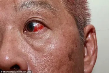 Doctors warn that subtle changes in the appearance of the eyes can signal serious diseases early