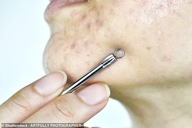 Last-Minute Pimple Popping: A Skin Expert's Urgent Warning About Long-Term Scars and Inflammation
