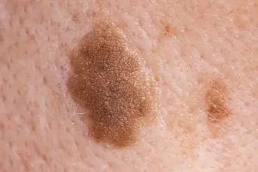 Skin Deep: Exploring the Complexity and Vulnerability of Our Body's Largest Organ