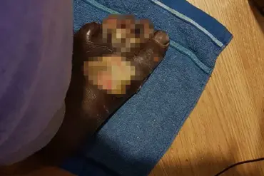 ‘It started with a small burn’: Father’s DIY Pedicure Leads to Life-Threatening Infection and Amputation