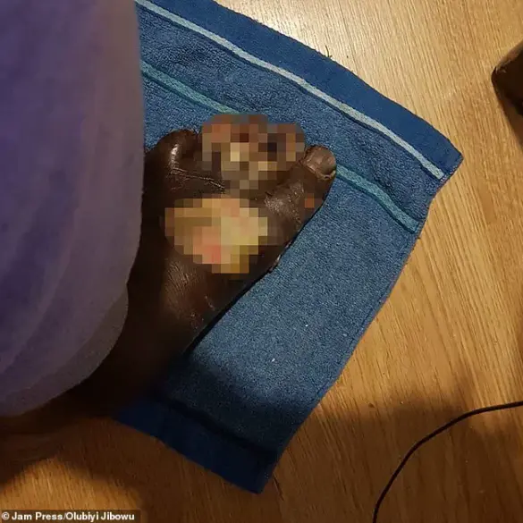 ‘It started with a small burn’: Father’s DIY Pedicure Leads to Life-Threatening Infection and Amputation