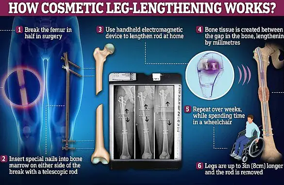 Leon Otremba's Leg-Lengthening Surgeries and the Global Attention They Generated