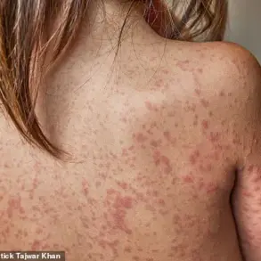 Public Health Officials Warn of Measles Resurgence as Cases Surge Among Unvaccinated Children and Teens