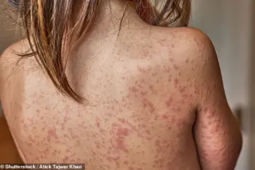 Public Health Officials Warn of Measles Resurgence as Cases Surge Among Unvaccinated Children and Teens