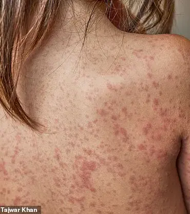 Public Health Officials Warn of Measles Resurgence as Cases Surge Among Unvaccinated Children and Teens