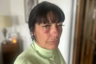 Regulatory Gaps in Aesthetic Treatments Put Public at Risk