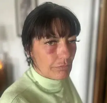 Regulatory Gaps in Aesthetic Treatments Put Public at Risk