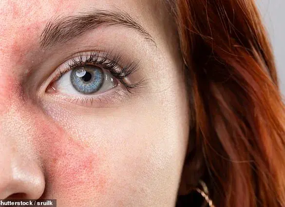 A Decades-Long Struggle with Acne and Rosacea: The Impact of Chronic Skin Conditions on Daily Life