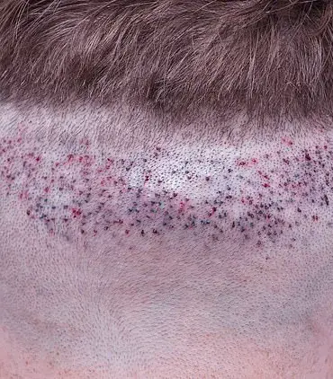 BAHRS Warns of Risks from Unlicensed Hair Transplants in UK