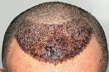 Cheap Hair Transplants: A Surgeon Warns of Irreversible Damage from Global Clinics