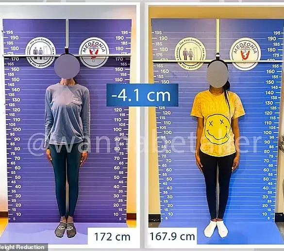 Controversial Leg Shortening Surgery in Turkey Sparks Debate Over Beauty Standards and Personal Choice