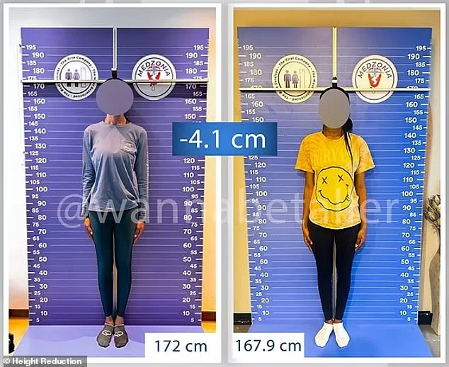 Controversial Leg Shortening Surgery in Turkey Sparks Debate Over Beauty Standards and Personal Choice