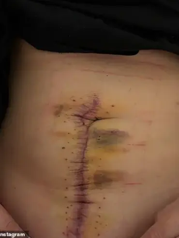 From Discomfort to Diagnosis: A Personal Journey with a Hidden Illness