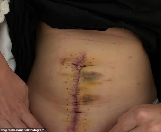 From Discomfort to Diagnosis: A Personal Journey with a Hidden Illness