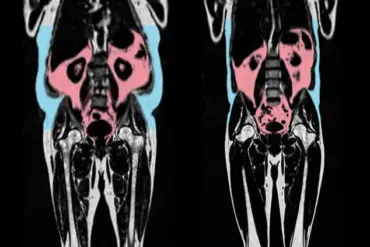 Hidden Visceral Fat Poses Heart Attack Risk for Slim Individuals, Research Finds