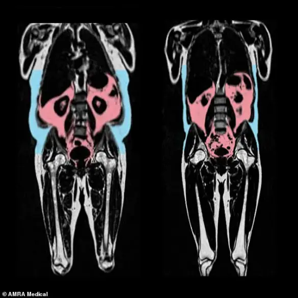 Hidden Visceral Fat Poses Heart Attack Risk for Slim Individuals, Research Finds