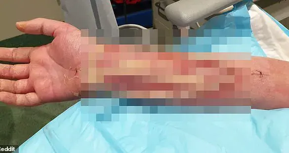 Severe Infection from Dog Bite Leads to Life-Threatening Ordeal for Australian Man