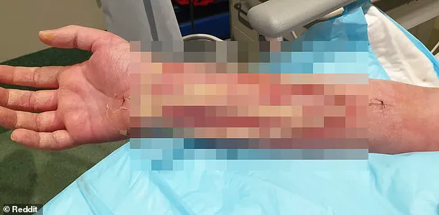 Severe Infection from Dog Bite Leads to Life-Threatening Ordeal for Australian Man