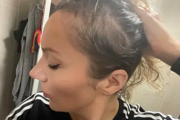 The Lifeline of Sunlight: How Weather Shapes the Experience of Hair Loss Concealment