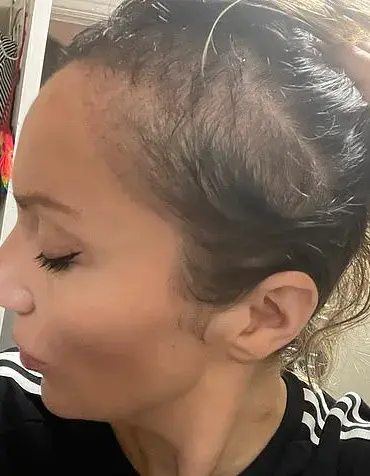 The Lifeline of Sunlight: How Weather Shapes the Experience of Hair Loss Concealment